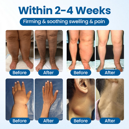 Timilk® Lymphora Swelling Relief Roll-On⭐